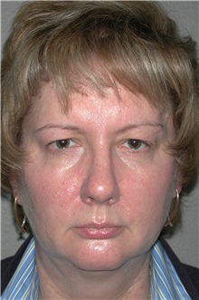 Eyelid Surgery Before Photo by Dann Leonard, MD; Salem, OR - Case 8715