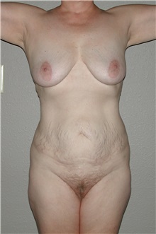Liposuction After Photo by Dann Leonard, MD; Salem, OR - Case 8718