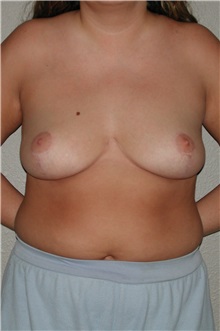 Breast Reduction After Photo by Dann Leonard, MD; Salem, OR - Case 8733