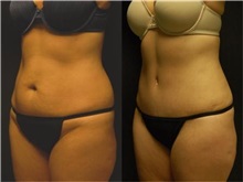 Tummy Tuck After Photo by Robert Lowen, MD; Mountain View, CA - Case 50161