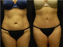 Tummy Tuck Before Photo by Robert Lowen, MD; Mountain View, CA - Case 50161