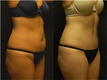 Tummy Tuck After Photo by Robert Lowen, MD; Mountain View, CA - Case 50161