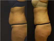 Tummy Tuck Before Photo by Robert Lowen, MD; Mountain View, CA - Case 50161