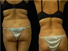 Tummy Tuck After Photo by Robert Lowen, MD; Mountain View, CA - Case 50160