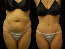 Tummy Tuck Before Photo by Robert Lowen, MD; Mountain View, CA - Case 50160