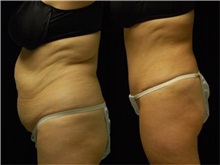 Tummy Tuck After Photo by Robert Lowen, MD; Mountain View, CA - Case 50160