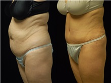 Tummy Tuck Before Photo by Robert Lowen, MD; Mountain View, CA - Case 50160