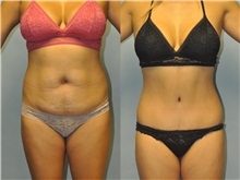 Tummy Tuck Before Photo by Robert Lowen, MD; Mountain View, CA - Case 50163