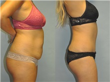 Tummy Tuck After Photo by Robert Lowen, MD; Mountain View, CA - Case 50163