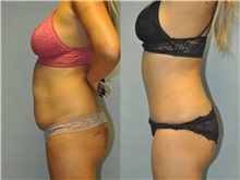 Tummy Tuck Before Photo by Robert Lowen, MD; Mountain View, CA - Case 50163