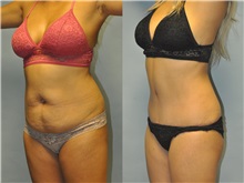 Tummy Tuck After Photo by Robert Lowen, MD; Mountain View, CA - Case 50163