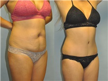 Tummy Tuck Before Photo by Robert Lowen, MD; Mountain View, CA - Case 50163