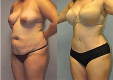 Tummy Tuck After Photo by Robert Lowen, MD; Mountain View, CA - Case 50158
