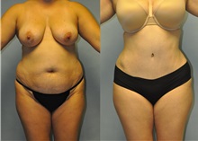 Tummy Tuck Before Photo by Robert Lowen, MD; Mountain View, CA - Case 50158