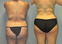 Tummy Tuck After Photo by Robert Lowen, MD; Mountain View, CA - Case 50158