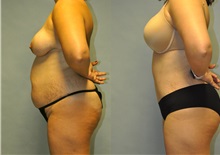 Tummy Tuck Before Photo by Robert Lowen, MD; Mountain View, CA - Case 50158