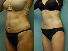 Tummy Tuck After Photo by Robert Lowen, MD; Mountain View, CA - Case 50162