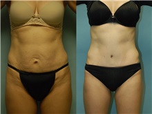 Tummy Tuck Before Photo by Robert Lowen, MD; Mountain View, CA - Case 50162