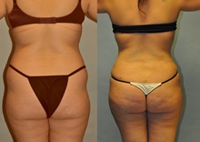 Tummy Tuck After Photo by Robert Lowen, MD; Mountain View, CA - Case 50164