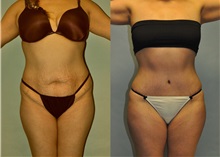 Tummy Tuck Before Photo by Robert Lowen, MD; Mountain View, CA - Case 50164