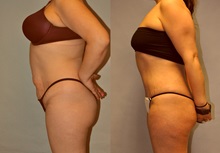 Tummy Tuck After Photo by Robert Lowen, MD; Mountain View, CA - Case 50164