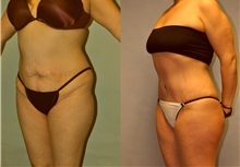 Tummy Tuck Before Photo by Robert Lowen, MD; Mountain View, CA - Case 50164