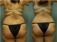 Tummy Tuck After Photo by Robert Lowen, MD; Mountain View, CA - Case 50166