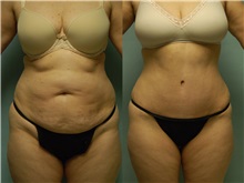Tummy Tuck Before Photo by Robert Lowen, MD; Mountain View, CA - Case 50166