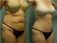 Tummy Tuck After Photo by Robert Lowen, MD; Mountain View, CA - Case 50166