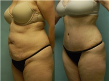 Tummy Tuck Before Photo by Robert Lowen, MD; Mountain View, CA - Case 50166