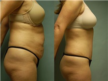 Tummy Tuck After Photo by Robert Lowen, MD; Mountain View, CA - Case 50166