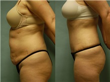 Tummy Tuck Before Photo by Robert Lowen, MD; Mountain View, CA - Case 50166