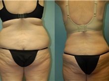 Tummy Tuck After Photo by Robert Lowen, MD; Mountain View, CA - Case 50167
