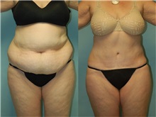 Tummy Tuck Before Photo by Robert Lowen, MD; Mountain View, CA - Case 50167