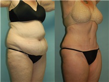 Tummy Tuck After Photo by Robert Lowen, MD; Mountain View, CA - Case 50167