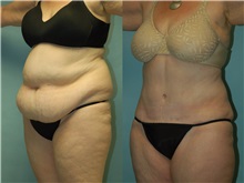 Tummy Tuck Before Photo by Robert Lowen, MD; Mountain View, CA - Case 50167