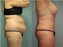 Tummy Tuck After Photo by Robert Lowen, MD; Mountain View, CA - Case 50167
