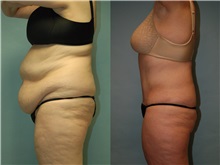 Tummy Tuck Before Photo by Robert Lowen, MD; Mountain View, CA - Case 50167