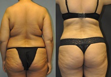 Tummy Tuck After Photo by Robert Lowen, MD; Mountain View, CA - Case 50169