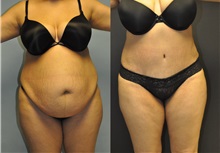 Tummy Tuck Before Photo by Robert Lowen, MD; Mountain View, CA - Case 50169