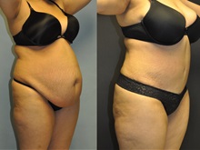 Tummy Tuck After Photo by Robert Lowen, MD; Mountain View, CA - Case 50169