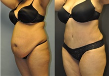 Tummy Tuck Before Photo by Robert Lowen, MD; Mountain View, CA - Case 50169