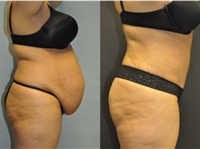 Tummy Tuck After Photo by Robert Lowen, MD; Mountain View, CA - Case 50169