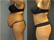 Tummy Tuck Before Photo by Robert Lowen, MD; Mountain View, CA - Case 50169