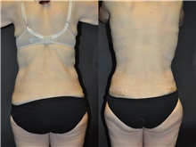 Body Contouring After Photo by Robert Lowen, MD; Mountain View, CA - Case 50171