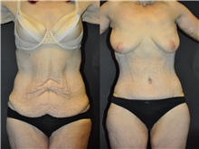 Body Contouring Before Photo by Robert Lowen, MD; Mountain View, CA - Case 50171