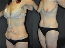 Body Contouring After Photo by Robert Lowen, MD; Mountain View, CA - Case 50171