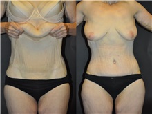 Body Contouring Before Photo by Robert Lowen, MD; Mountain View, CA - Case 50171