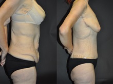 Body Contouring After Photo by Robert Lowen, MD; Mountain View, CA - Case 50171