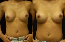 Breast Implant Revision After Photo by Robert Lowen, MD; Mountain View, CA - Case 50170